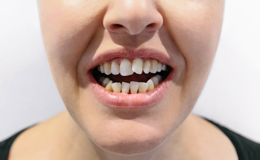 Zähne richten ohne Zahnspange